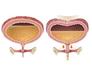 de blaas in het lichaam bij incontinentie en stress 300x250